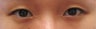 Bilateral Asian Eyelid Surgery