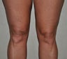 55 Year Old Female Treated For Knobby Knees