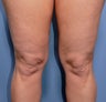 55 Year Old Female Treated For Knobby Knees