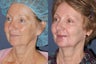 65 year old female with sun damage, wrinkling, lip lines, brown spots treated with Ultra Repair laser resurfacing