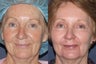 65 year old female with sun damage, wrinkling, lip lines, brown spots treated with Ultra Repair laser resurfacing