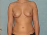 Breast Augmentation