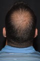 Hair Transplant