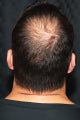 Hair Transplant