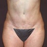43 Year Old Female with a Revised Tummy Tuck