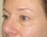 46 year old with eyelid bags undergoing filler treatment