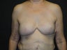 Implant-based breast reconstruction