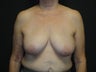 Implant-based breast reconstruction