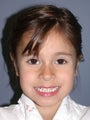Otoplasty/Ear Surgery