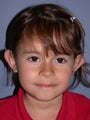 Otoplasty/Ear Surgery
