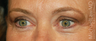 Eyelid Surgery - Blepharoplasty