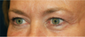Eyelid Surgery - Blepharoplasty