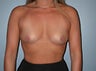 38 year old female patient 