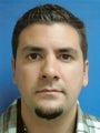 Otoplasty Ear Surgery - Male