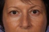 Lower Eyelid Surgery