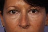 Lower Eyelid Surgery