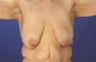 Breast Lift