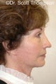 Facelift
