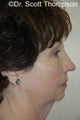 Facelift