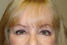 Endoscopic Browlift, Bilateral Upper and Lower Blepharoplasty, Canthopexy
