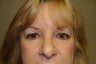 Endoscopic Browlift, Bilateral Upper and Lower Blepharoplasty, Canthopexy
