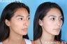 Rhinoplasty Patient