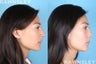 Rhinoplasty Patient