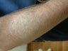 Laser Tattoo Removal