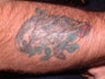 Laser Tattoo Removal