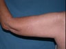 Arm Lift