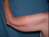 Arm Lift