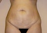 Tummy Tuck