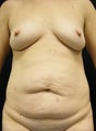Abdominoplasty and Augmentation