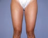 Liposuction