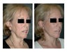 Lower Facelift for Extra Skin and Turkey Neck