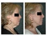 Lower Facelift for Extra Skin and Turkey Neck