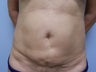 Revision Tummy Tuck with abdominal  liposuction