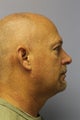 Neck Lipo, Chin Aug 