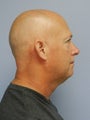 Neck Lipo, Chin Aug 