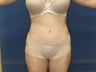 Tummy Tuck