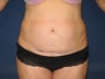 Tummy Tuck