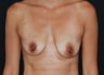 Breast Augmentation
