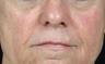 Juvederm Ultra Plus