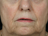 Juvederm Ultra Plus