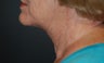 Direct Excision Neck Lift in a 70 year old (T-Z Plasty)