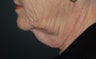 Direct Excision Neck Lift in a 70 year old (T-Z Plasty)