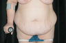 Tummy Tuck
