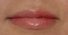 Juvederm in Lips