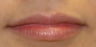 Juvederm in Lips