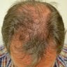 53 year old male before and after 1 year on Propecia